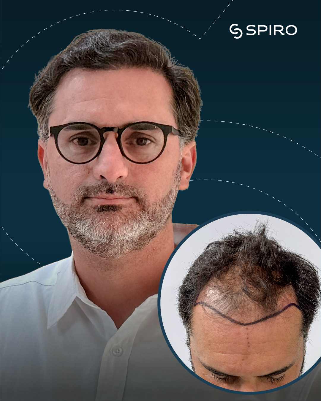 Trasplante Capilar en SPIRO